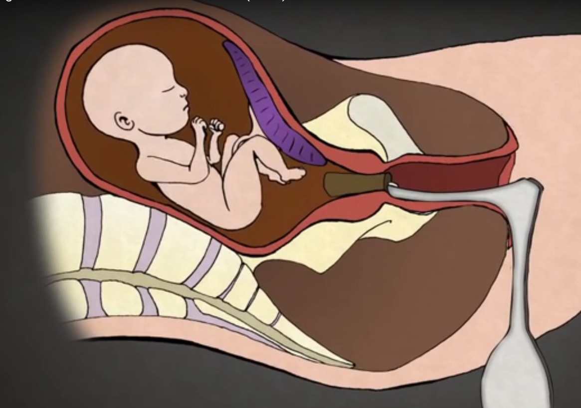 VIDEO: UZNEMIRUJUĆE - Ovo je prava istina o pobačaju, o ženi i njezinom plodu